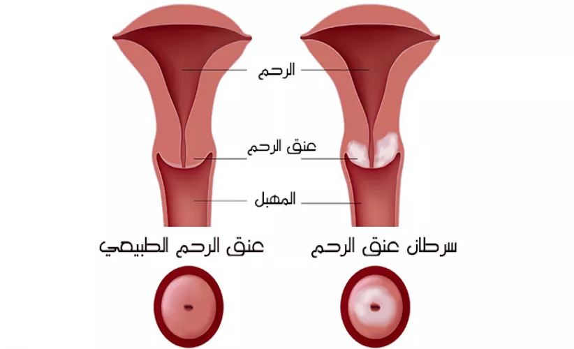 HPV